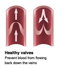 Healthy Valves

