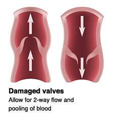 Damaged Valves
